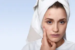 acne-issues