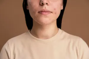 Pitted-acne