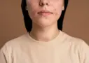 Pitted-acne