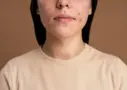 Pitted-acne