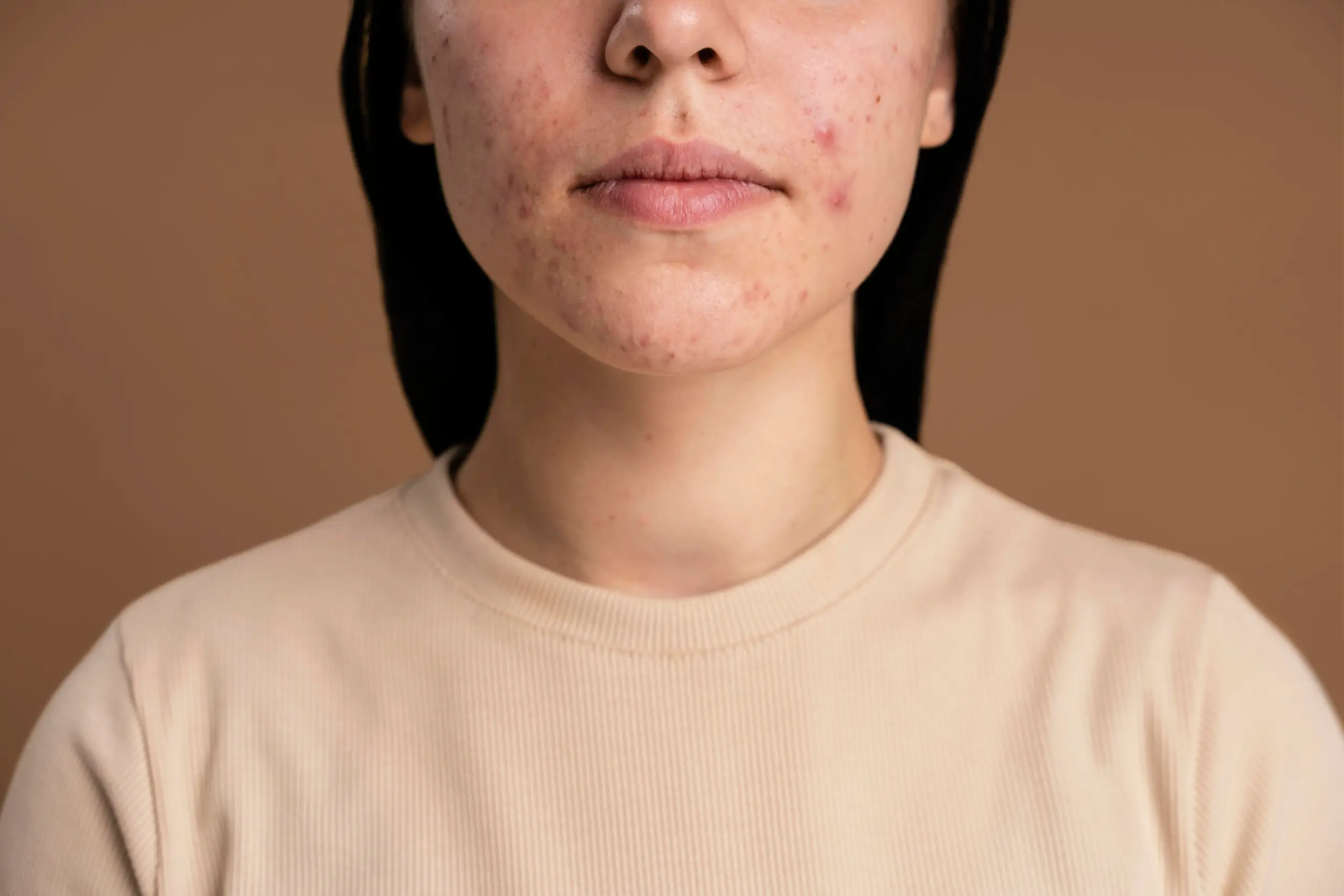 Pitted-acne